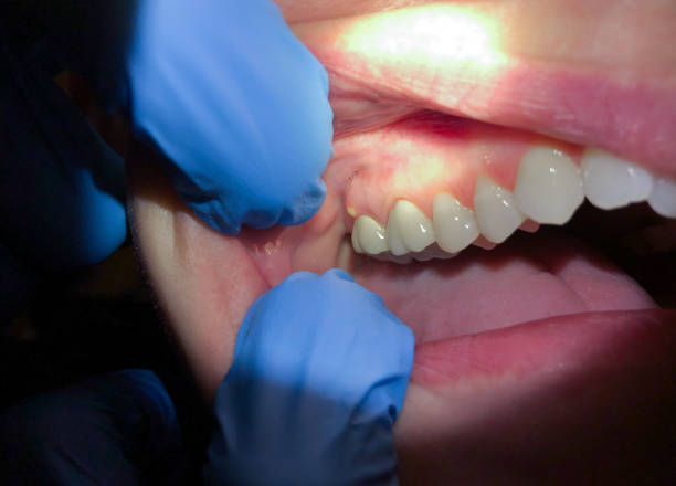 Best Emergency Tooth Extraction  in Mount Vernon, GA
