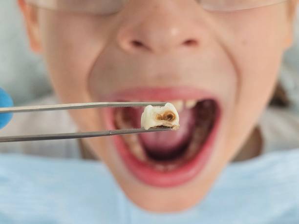 Urgent Tooth Repair in GA